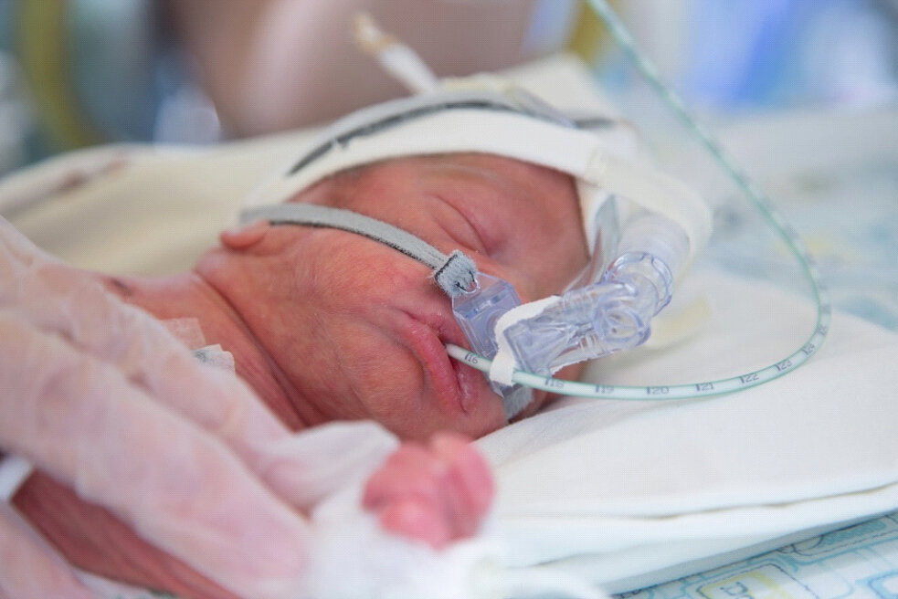 Кормление недоношенного ребенка через зонд.