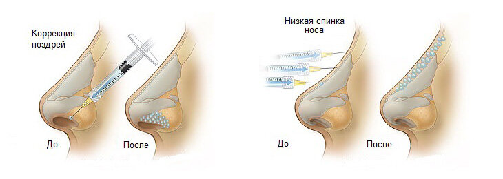 Пластика носа