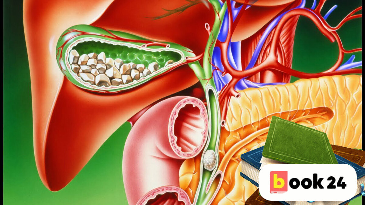 Желчекаменная болезнь холецистит