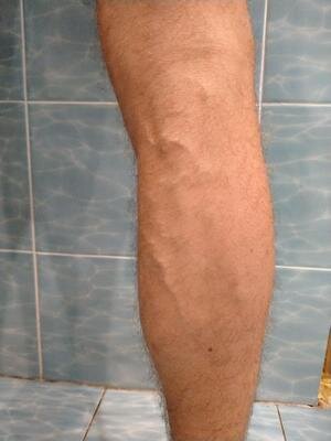 Имеется вот такой лапоть с варикозом.