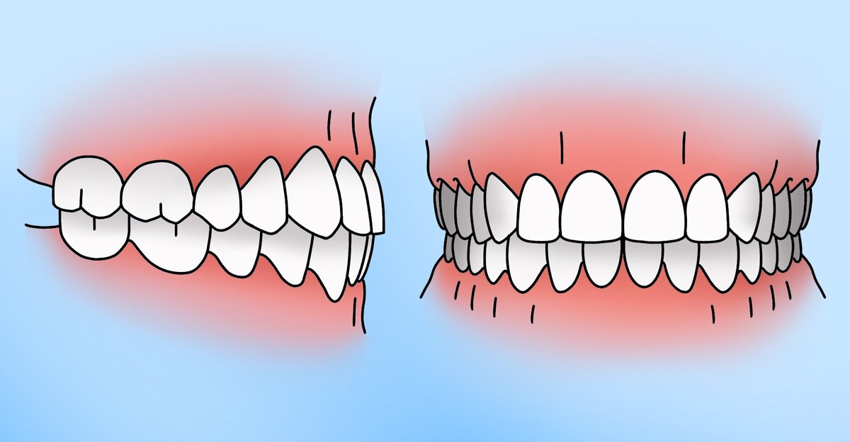 Как выглядит правильный прикус