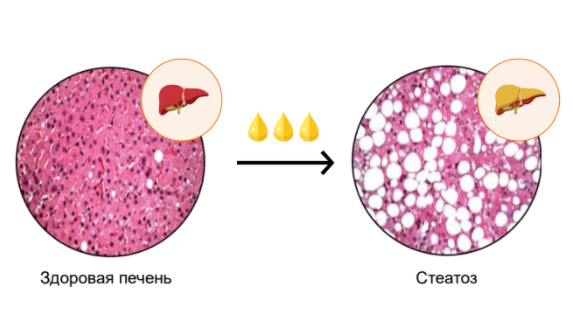 При стеатозе капли жира накапливаются в печени и не дают ей полноценно выполнять свои функции 