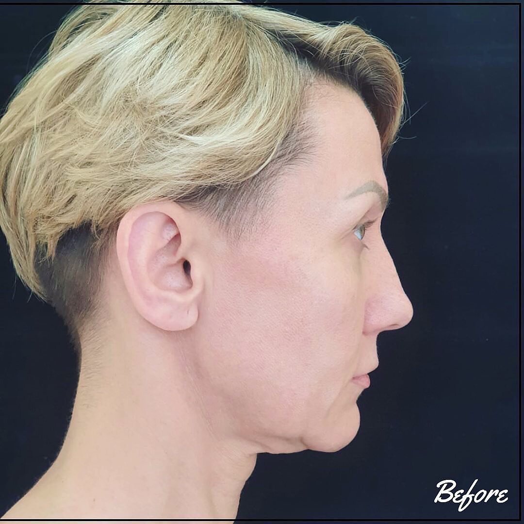 Тотальное омоложение лица с пластикой лица и шеи Macs-Lift Standart или Macs-Lift Advance. Фото из инстаграм клиники.  Имеются противопоказания, требуется консультация специалиста