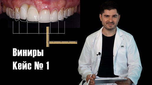 Виниры Кейс № 1. Накладная десна. Два комплекта виниров. Восстановление функции сустава