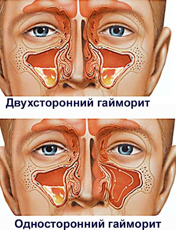 Схема лечения двухстороннего гайморита