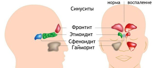 Часто на прием к педиатру обращаются родители с жалобами на длительную заложенность носа, слизисто - гнойные выделениями из носа плотной, густой консистенции, сниженным обонянием, головными болями, слабостью и повышением температуры.
В этом случае у малышей часто диагностируется синусит.
Болезнь бывает бактериальной, вирусной, грибковой или аллергической, природы.
