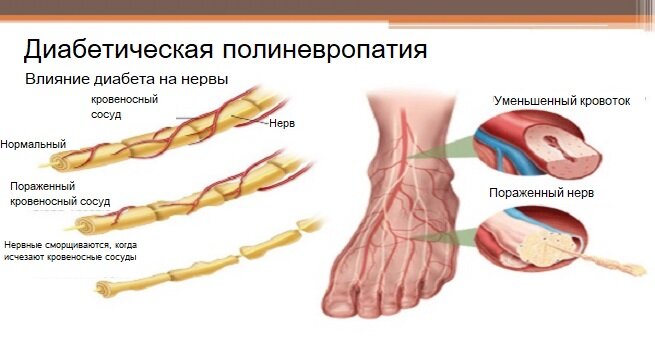 Заболевания нервов и сплетений