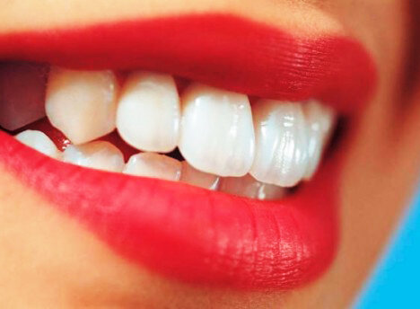 Есть ли побочные эффекты от отбеливания зубов? Мнение стоматолога.