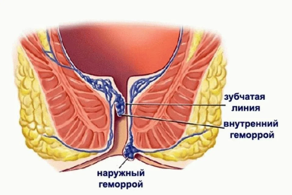 Колики в заднем. Геморрой в прямой кишке внутри.