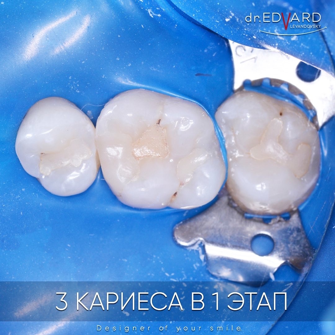 Старые дефектные пломбы