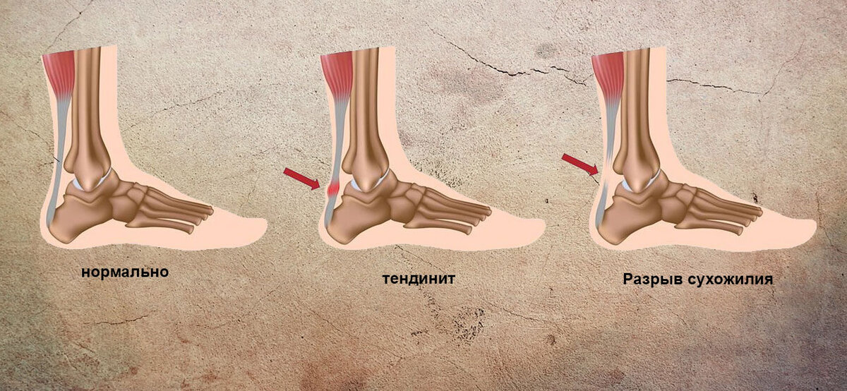 Ахиллово сухожилие разрыв ахиллова сухожилия. Повреждение ахиллова сухожилия. Ахиллово сухожилие на голеностопе. Разрыв ахиллова сухожилия. Растяжка голеностопа.