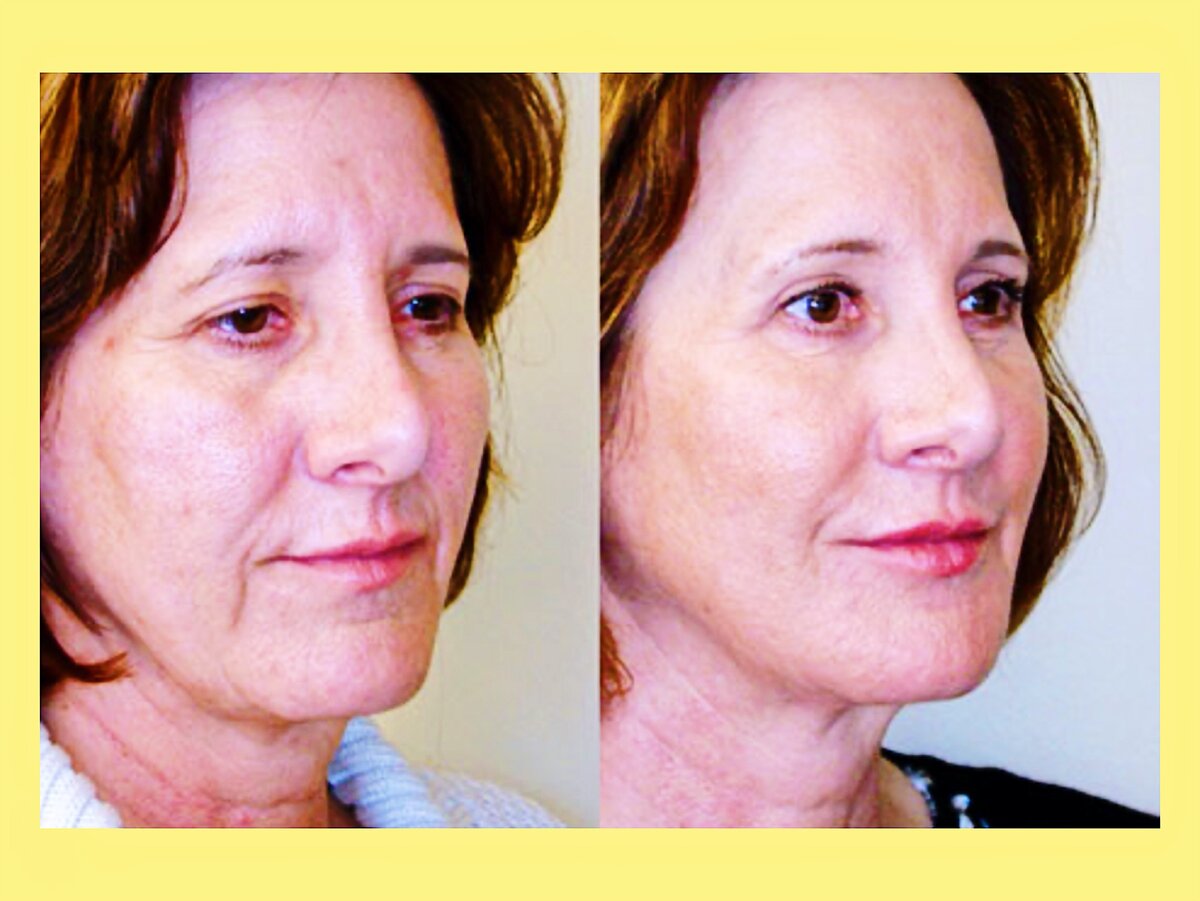 Брыли (лифтинг нефертити). Подтяжка лица в молодом возрасте. Золотые нити для подтяжки лица. Подтяжка лица в каком возрасте. Подтяжка лица в каком возрасте.