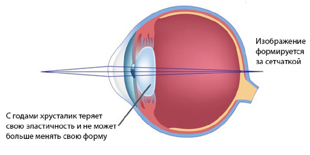 Хрусталик здорового глаза человека по форме похож. Пресбиопия (возрастная дальнозоркость). Пресбиопия обоих глаз. Пресбиопия механизм формирования. Пресбиопия схема.