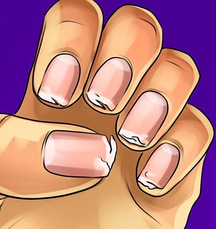 Хрупкие ногти.