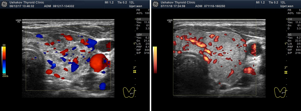 В режиме цдк аваскулярное. Цветное допплеровское картирование щитовидной железы. Цветовое допплеровское картирование кровотока. Узлы щитовидной железы на УЗИ. Кровоток щитовидной железы УЗИ.