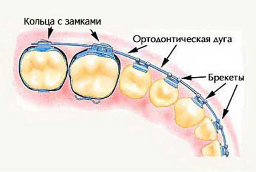 Схема ношения эластиков ортодонтия