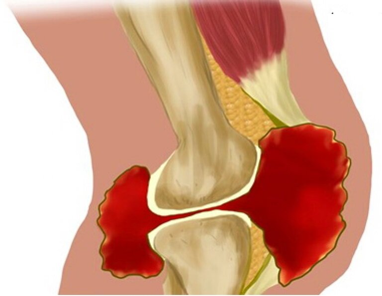Кровоизлияние в сустав. Гипортоз коленного суствва. Геопароз каленого сустава.