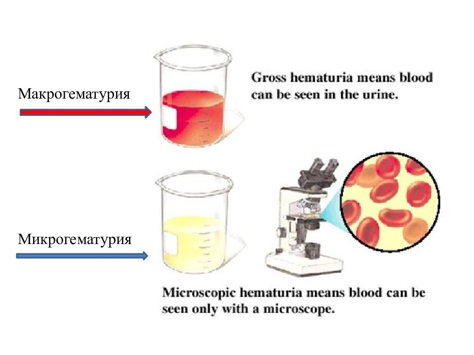 Моча мясных. Гематурия макро и микро. Макрогематурия и микрогематурия. Макрогематурия, микрогемат. Микрогематурия в моче.