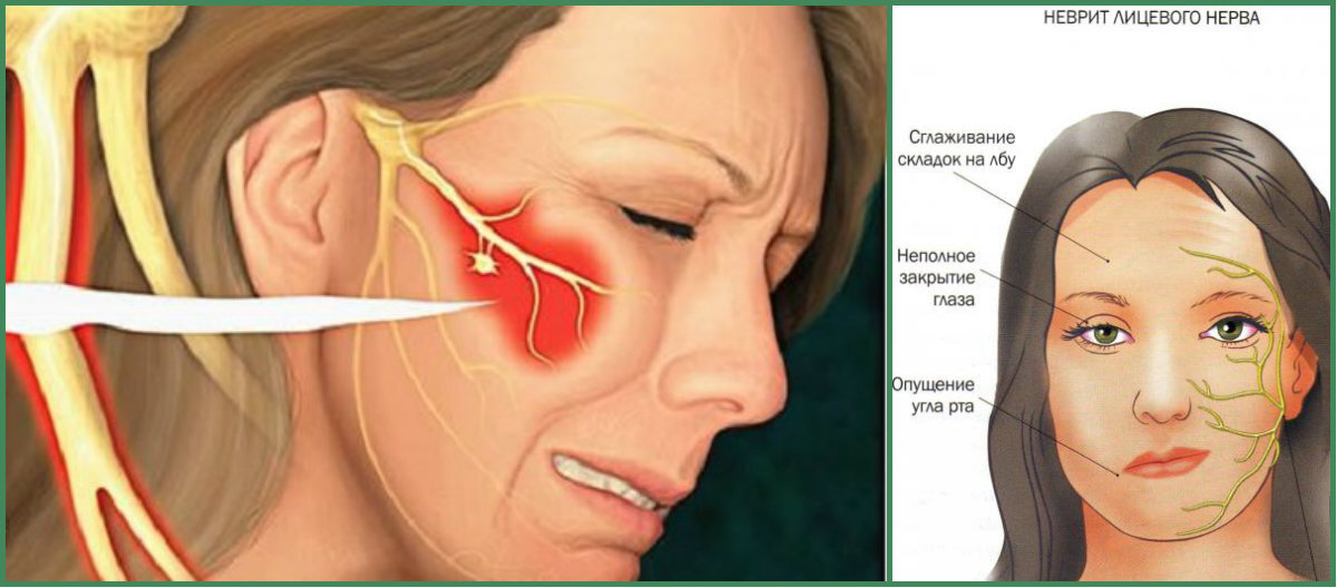 Больно открыть. Воспаление тройничного нерва. Порез лицевого нерва и тройничного. Воспаление тройничного лицевого нерва симптомы.