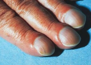 Ногти Гиппократа