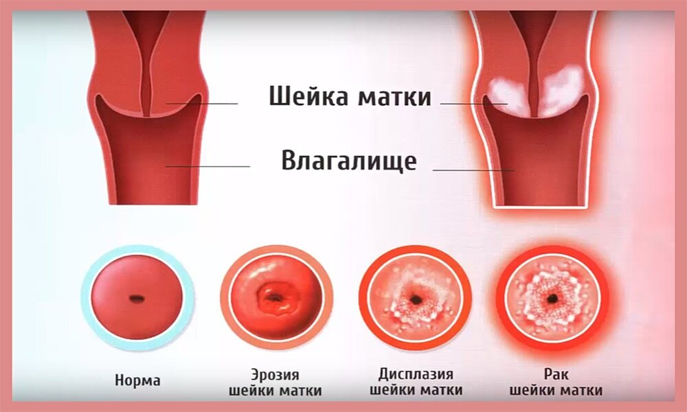 Патология шейки матки