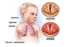 Отек гортани (хорошо видим, что проходимость дыхательных путей в области голосовых связок значительно меньше )