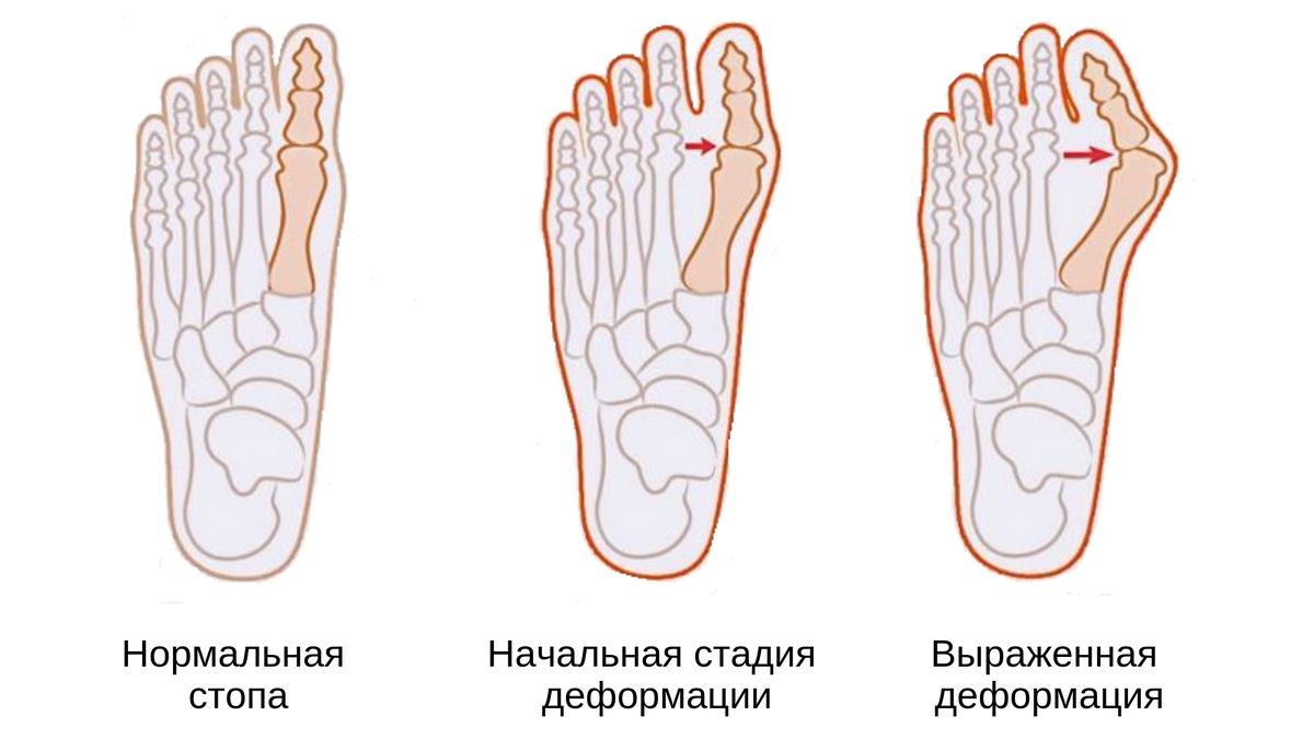 Растет косточка на ноге. Вальгусная деформация большого пальца стопы. Поперечное плоскостопие вальгус. Вальгусная деформация 1 пальца стопы. Варусная деформация плюсны.