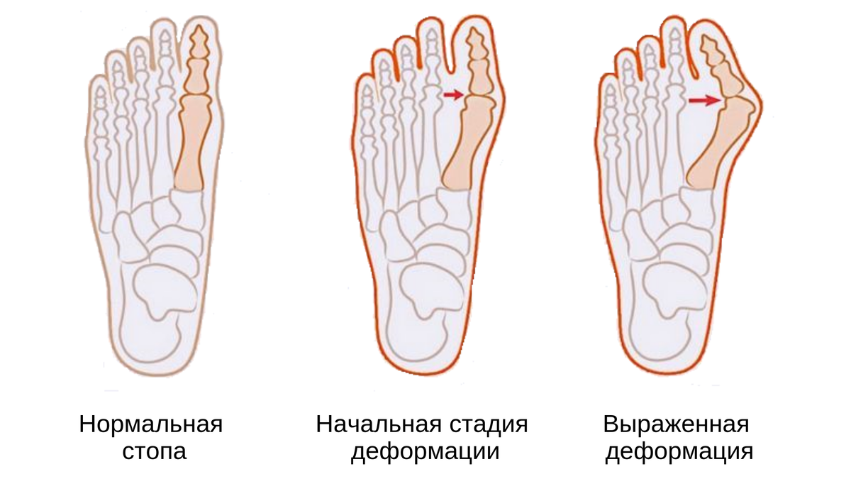 Внешняя стопа. Вальгусная деформация большого пальца стопы. Поперечное плоскостопие вальгус. Вальгусная деформация 1 пальца стопы. Варусная деформация плюсны.