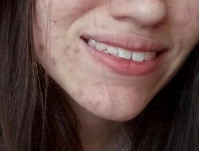 так выглядела моя кожа до примера роаккутанаа 