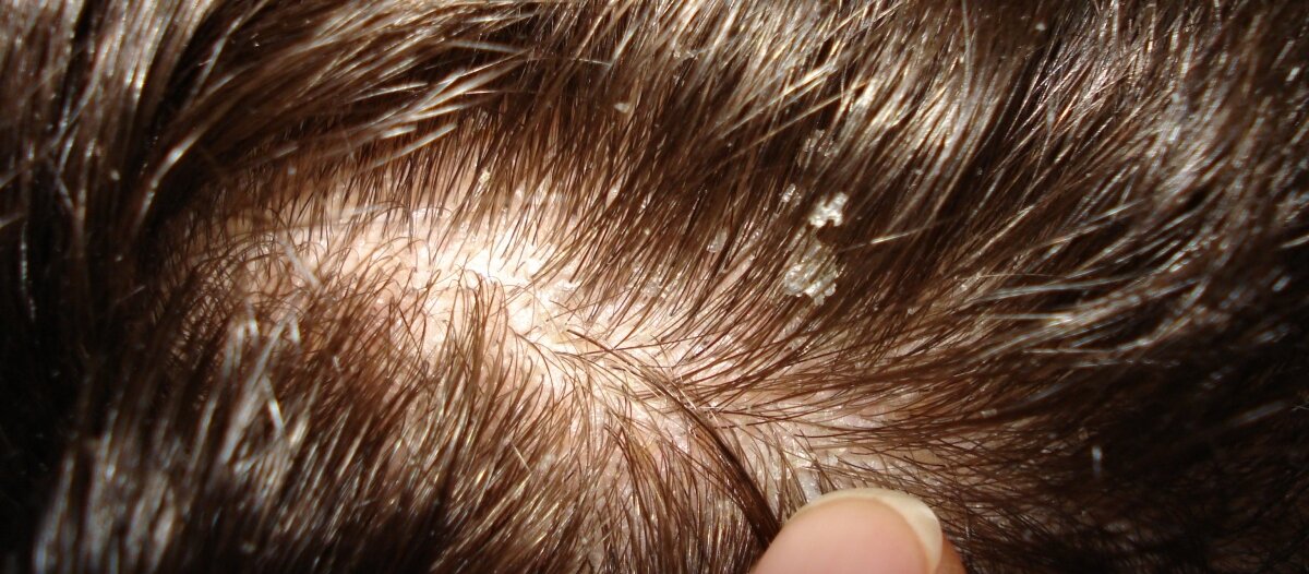 Волосы под лупой. Лечение перхоти у ребенка 10 лет. Детям от перхоти 2 года. Лечение перхоти у ребенка 10 лет. Лечение перхоти у ребенка 10 лет.