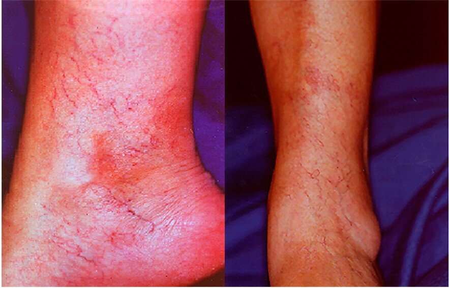 Телеангиоэктазии и ретикулярный варикоз. Фото