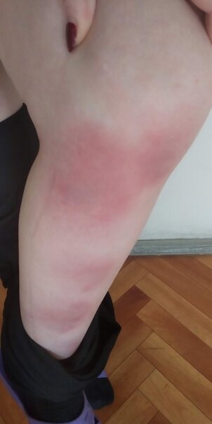 Состояние моих ног на 4й день болезни. 