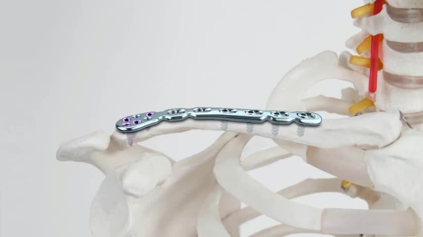 Остеосинтез пластинами при переломе ключицы