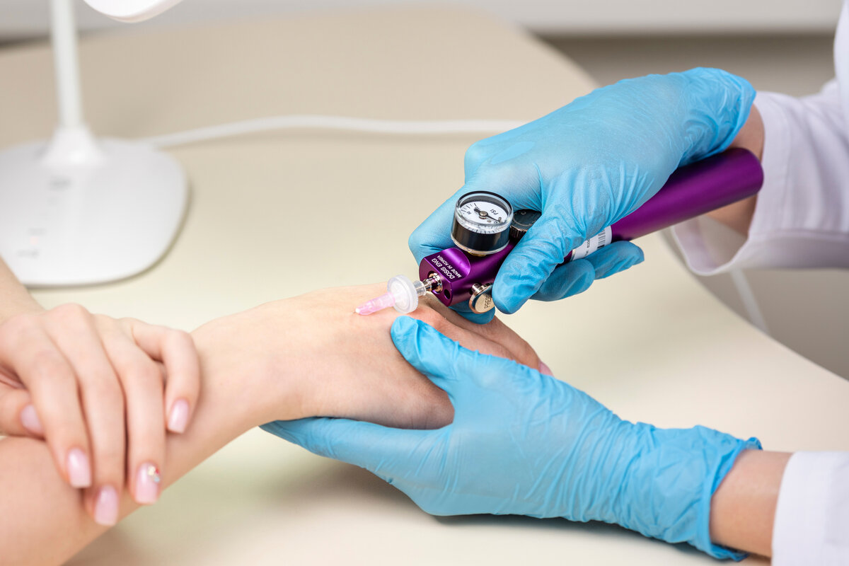 На фото фрагмент карбокситерапии кистей рук