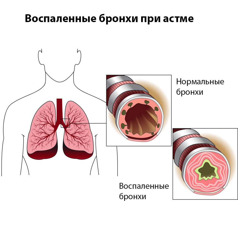 Все о детском кашле