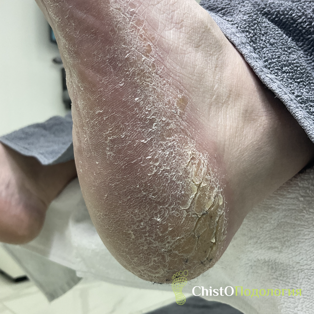 Пациент с трещинами 