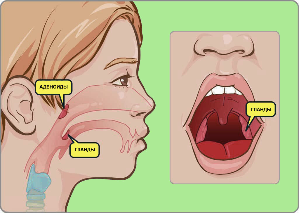 Миндалины: аденоиды и гланды
