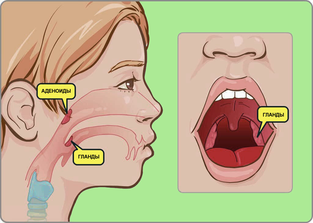 что такое аденоиды у детей фото | Дзен