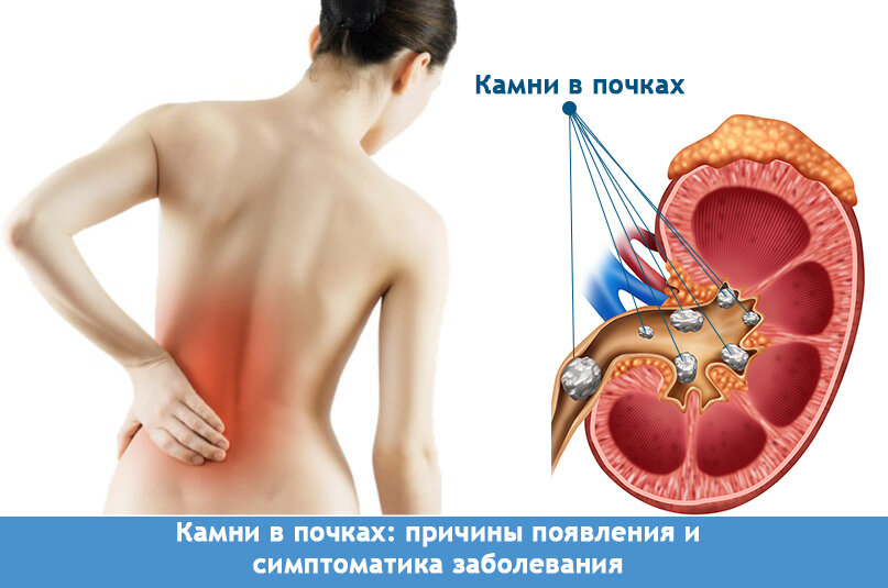 Камни в посках симптом. Кампив почках симптомы. КАМНИТВ почках симптомы.