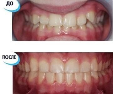 Пример исправлений глубокого прикуса