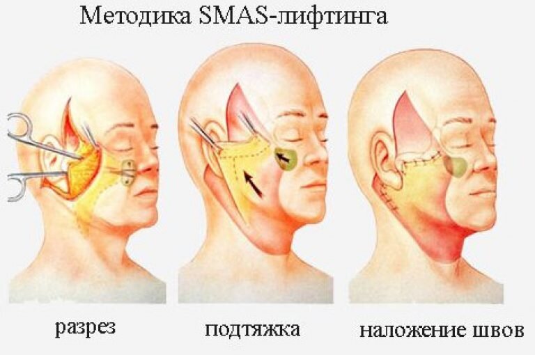 Так выглядит хирургический SMAS лифтинг