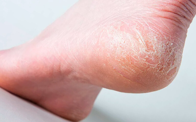 Фото трещин на пяточках с грибком