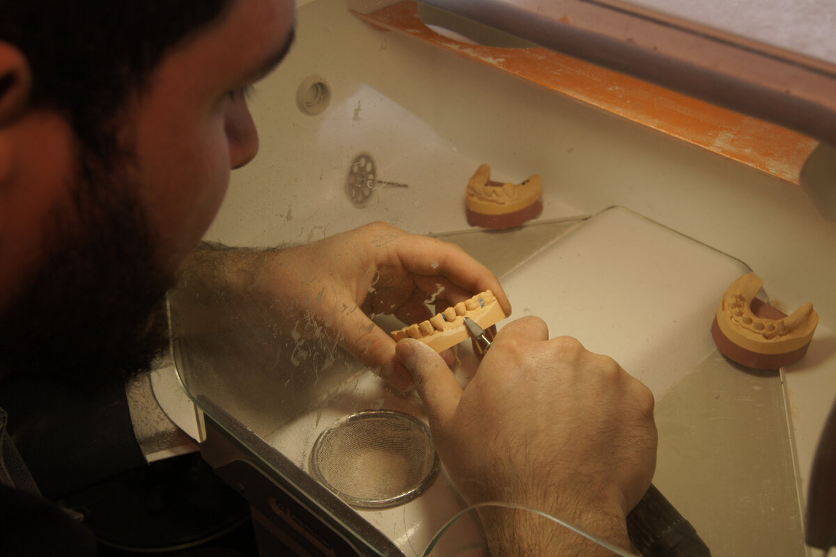 Обработка техником рабочих моделей (точной гипсовой копии полости рта пациента)