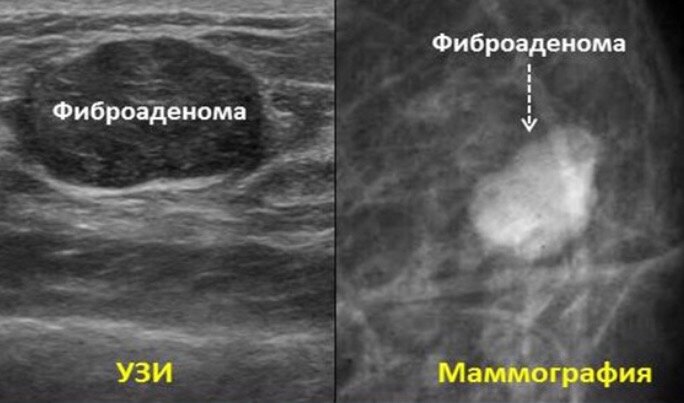 Вот он тот самый подвижный шарик в груди.(фото из свободного доступа в интернете)