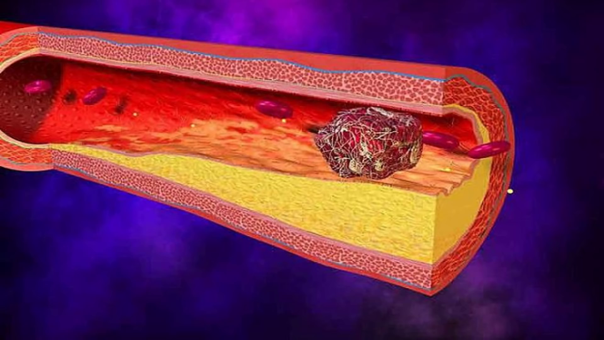 Как почистить сосуды от тромбов