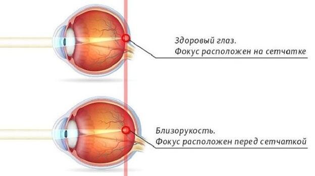 Лечение близорукости у детей в Харькове