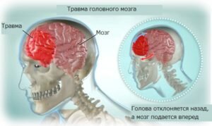 Сотрясение и ушиб головного мозга происходят по разным причинам, но в основном из-за механического воздействия. По статистике на первом месте стоят бытовые травмы около 35% из всех пациентов, чуть меньше жертвы автоаварий – 22%, 15% получают травмы при занятиях спортом. Остальная часть приходится на ушиб головного мозга и сотрясение головного мозга во время падения при эпилептическом припадке.