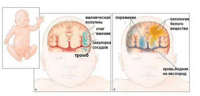 Поражение мозга