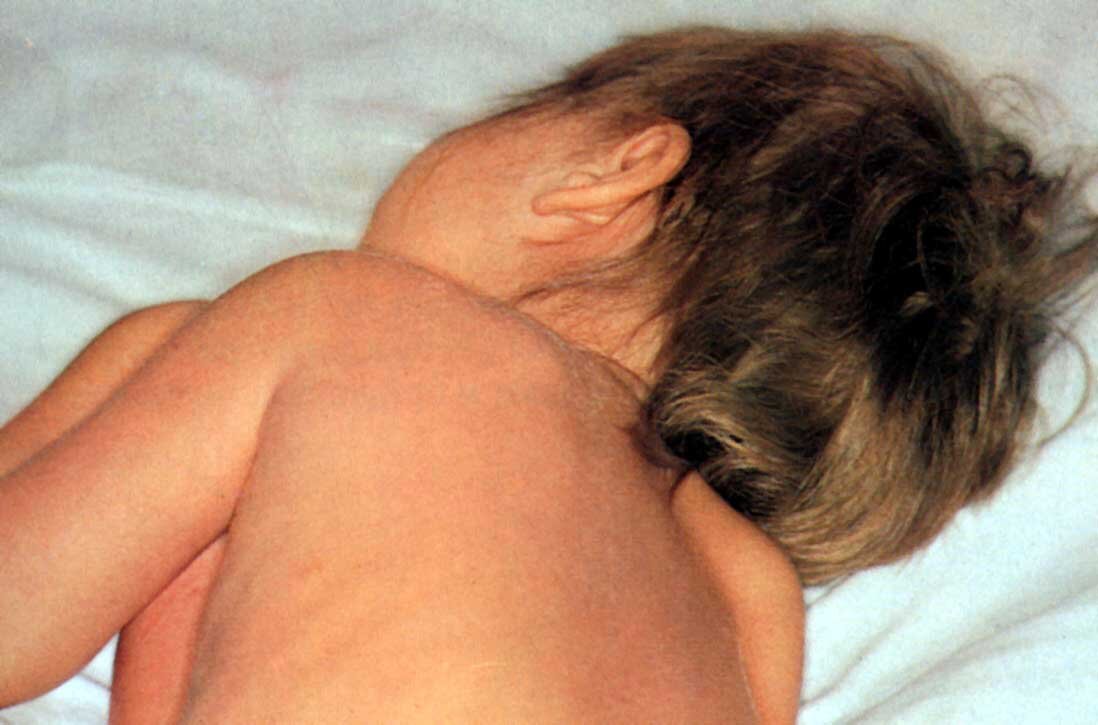 Голова запрокинута назад: типичная поза при менингите