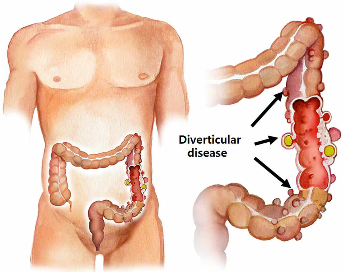Дивертикул кишечника картинки